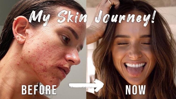 Overcoming Acne: Finding Peace and Reclaiming Your Skin's Story