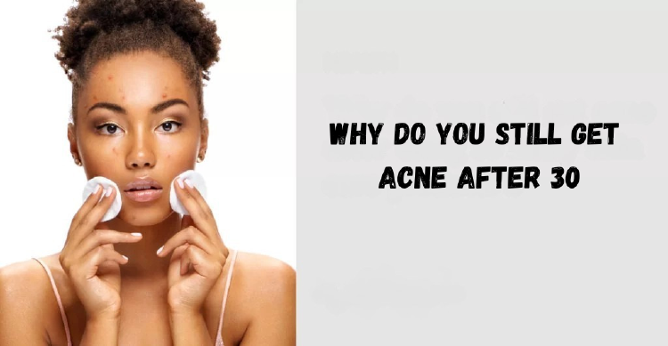 Why Does Acne Happen After 30?